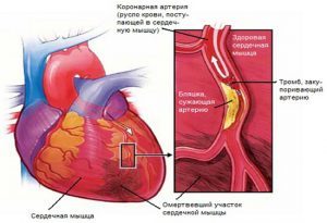 Какой врач лечит сосуды головного мозга, атеросклероз?