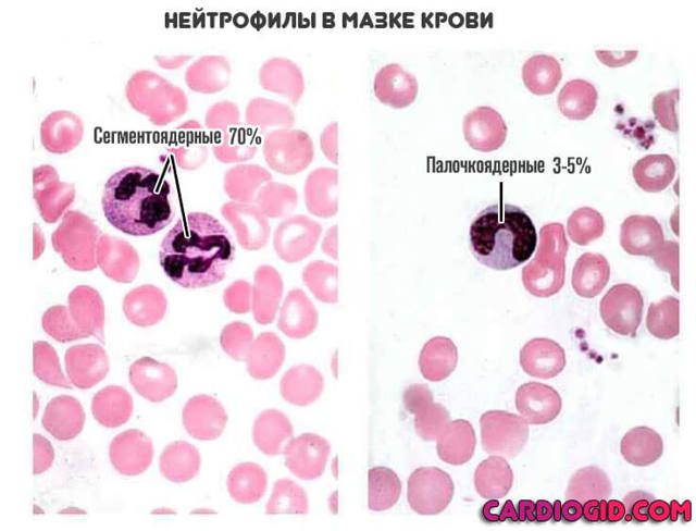 Нейтропения и ее причины. Лекарственная нейтропения