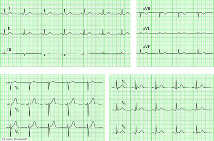 Стандартные отведения от конечностей - 1,2,3