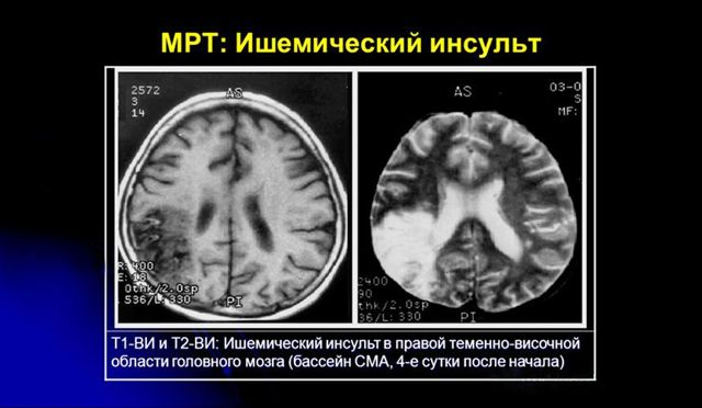 Ишемический инсульт головного мозга: прогноз для жизни у пожилых людей