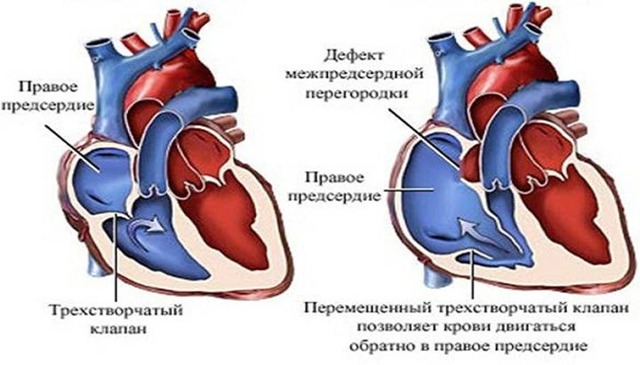 Дефект межпредсердной перегородки (ДМПП): причины, симптомы и особенности лечения