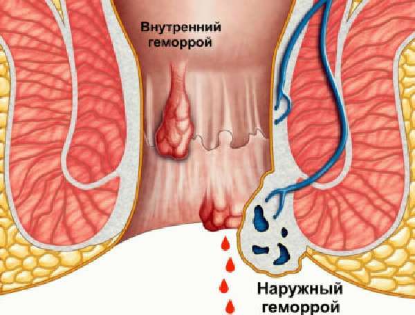 Как остановить кровотечение при геморрое в домашних условиях: эффективное лечение и рекомендации