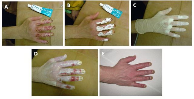 Сульфаргин - инструкция и показания к применению