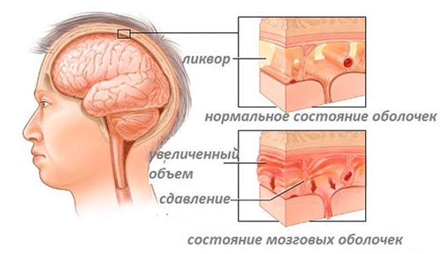 Расширение желудочков головного мозга у новорожденных