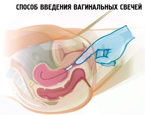Свечи клотримазол (таблетки вагинальные): инструкция по применению для женщин при молочнице, цена, отзывы, аналоги и заменители, можно ли при беременности?