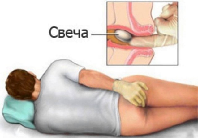 Свечи Бетиол – инструкция по применению, показания и противопоказания