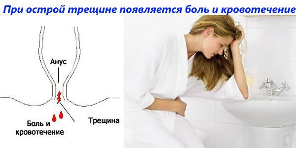 Лечение трещины заднего прохода без операции