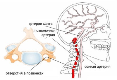 Синдром позвоночной артерии – причины, симптомы, лечение, упражнения при синдроме позвоночной артерии