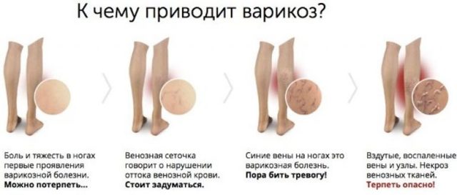 Симптомы варикозного расширения вен на ногах, степени и стадии варикоза