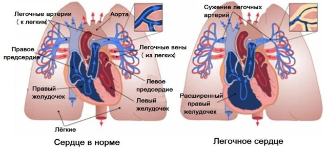 Что такое легочная гипертензия, её симптомы и лечение