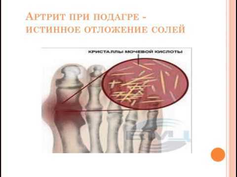 Мочевая кислота составляет уменя 755 что делать. Какая норма мочевой кислоты в крови мужчин, женщин и детей