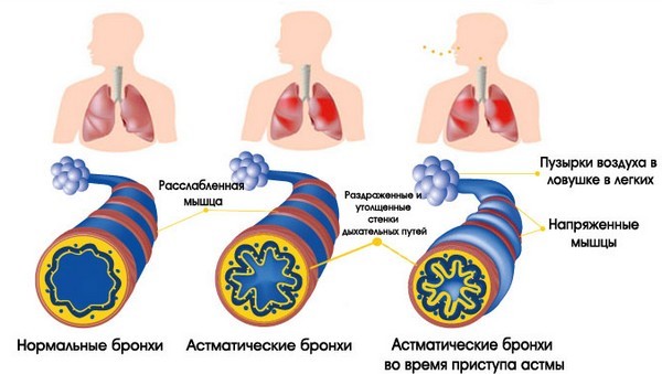 Тяжело дышать не хватает воздуха что делать