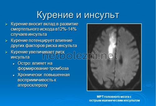 Инсульт левая или правая сторона, последствия, сколько живут