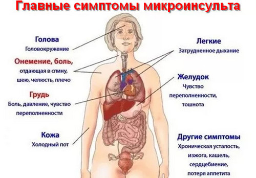 Микроинсульт – симптомы и последствия, признаки, лечение, или Берегите здоровье смолоду