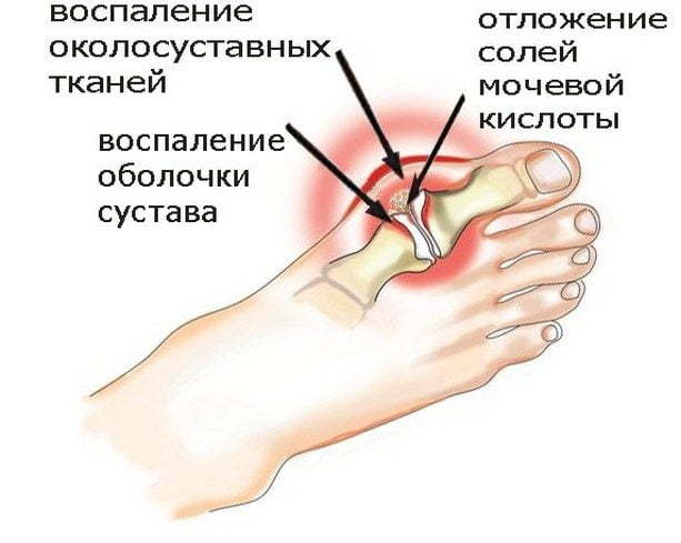 Артрит стопы симптомы и лечение — Суставы