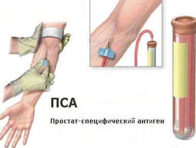 Анализ крови ПСА — что это такое? Расшифровка и норма