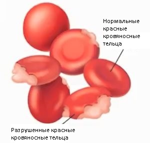 Как быстро понизить билирубин в крови в домашних условиях
