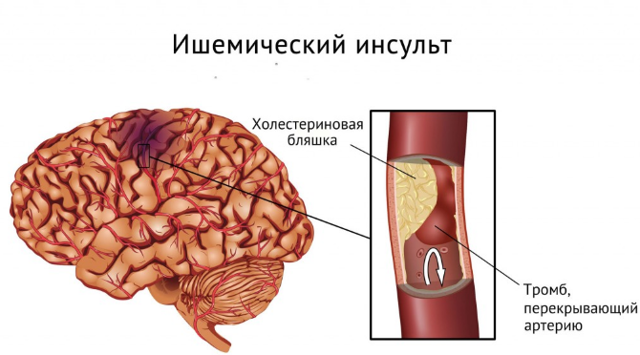 Инсульт левая или правая сторона, последствия, сколько живут