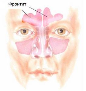 Острый фронтит что такое, симптомы и лечение у взрослых