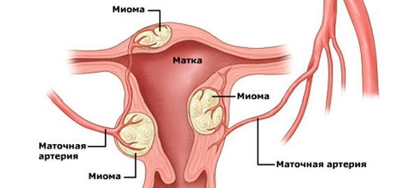 Миома матки: симптомы и лечение, признаки, фото