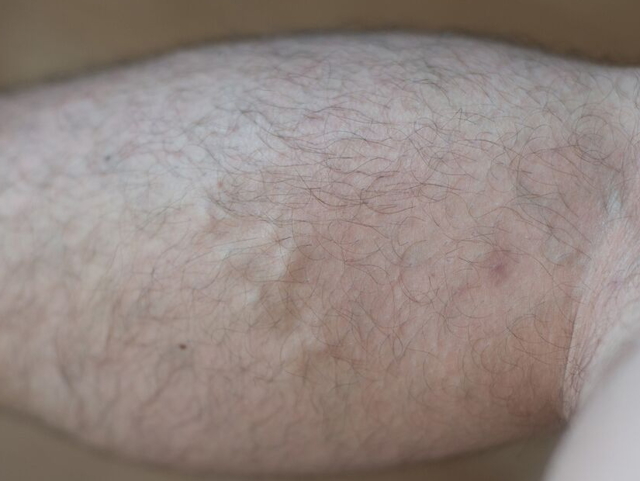 Начальная стадия варикоза на ногах: способы лечения и как распознать (симптомы, диагностика)