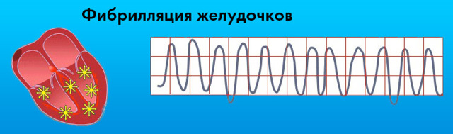 Картинки ЭКГ при нарушениях ритма