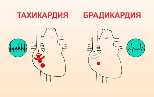 Низкий пульс при нормальном давлении: причины и способы лечения