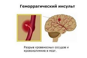 Геморрагический инсульт головного мозга: симптомы, последствия и лечение
