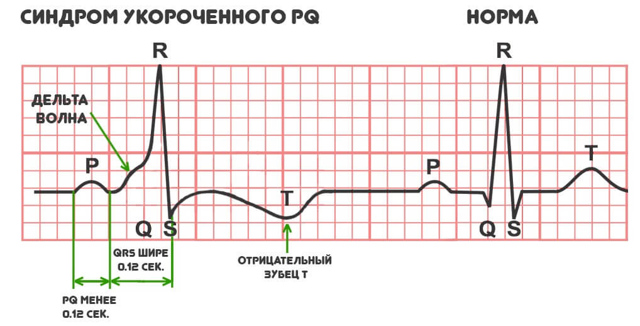 Синдром укороченного PQ: причины, симптомы, лечение