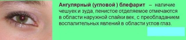 Блефарит – причины, симптомы и лечение блефарита век (фото)