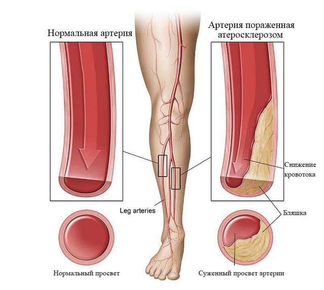 Атеросклероз сосудов нижних конечностей - симптомы и лечение - Всё о склерозе