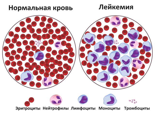 Современные методики лечения лейкоза и причины заболевания: лечится или нет, можно ли вылечить, у взрослых и детей