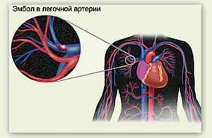 Почему оторвался тромб? Причины, симптомы и что делать?