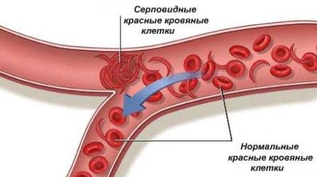 Анемический синдром у детей - online presentation