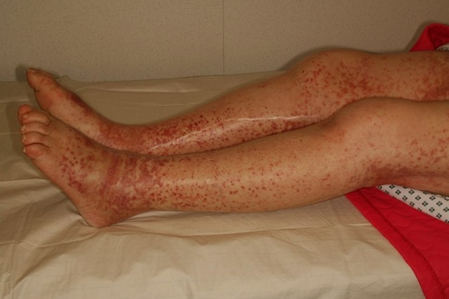 Идиопатическая тромбоцитопеническая пурпура.