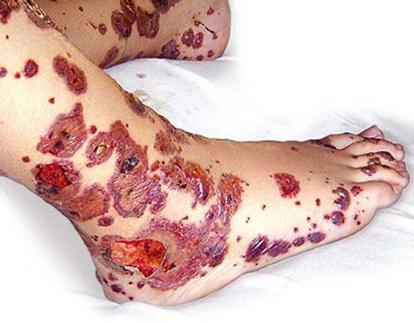 Васкулит на ногах - что это такое и как лечить?