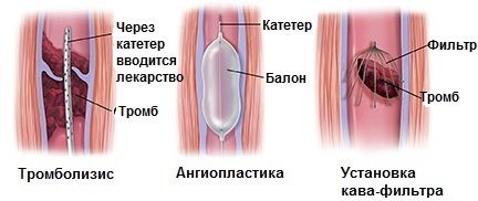 Тромбоз глубоких вен нижних конечностей - лечение в Инновационном сосудистом центре: симптомы, причины и профилактика