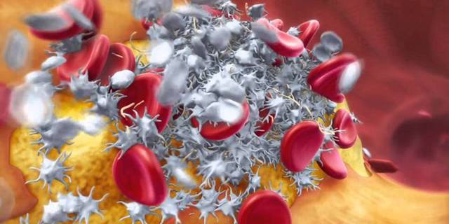 От чего происходит инфаркт миокарда