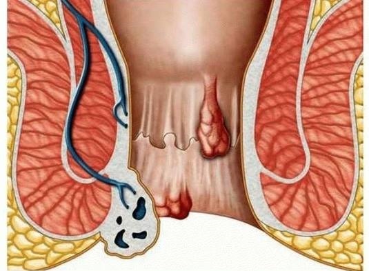 Лечение геморроя пиявками: куда их ставить в домашних условиях, отзывы