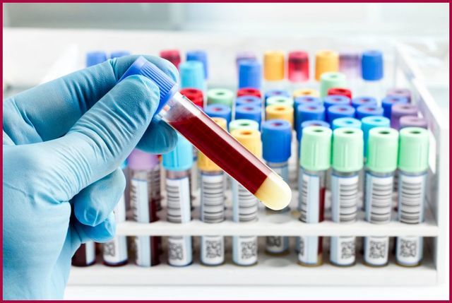 Неполная блокада правой ножки пучка Гиса – вид на ЭКГ