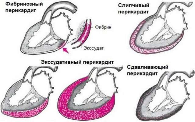 Перикардит: симптомы, лечение
