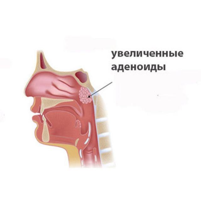 Лимфомиозот - инструкция по применению для детей при аденоидах, отзывы о препарате Лимфомиозот