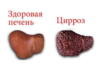 Анизоцитоз эритроцитов и тромбоцитов: причины патологии