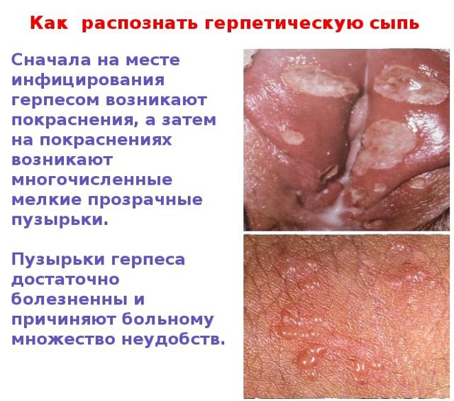 Генитальный герпес - фото проявлений у мужчин и женщин