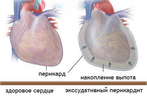 Сердечный горб что это такое - Лечение гипертонии
