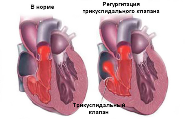 Регургитация трикуспидального клапана 1 степени