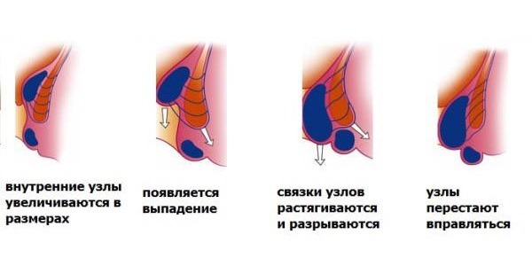 Геморрой: причины возникновения у мужчин и женщин, причины обострения