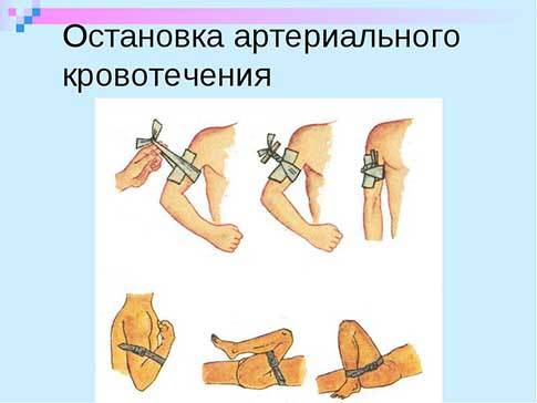 Первая помощь при артериальном кровотечении: алгоритм действий