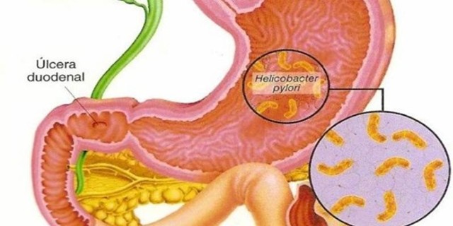 Катаральный гастрит - симптомы и лечение заболевания