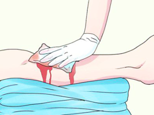 Кровотечения и способы их остановки
